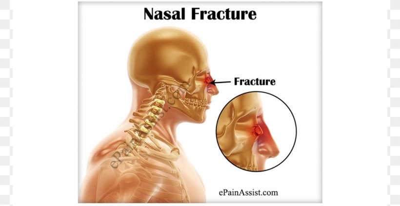 Nasal Fracture Nose Nasal Bone Bone Fracture Surgery, PNG, 1600x827px, Watercolor, Cartoon, Flower, Frame, Heart Download Free