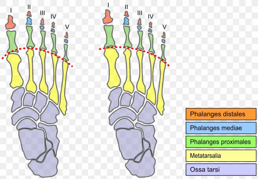 Morton's Toe Morton's Neuroma Foot Metatarsal Bones, PNG, 2000x1395px, Toe, Ache, Anatomy, Diagram, Disease Download Free