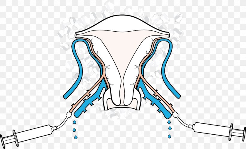 Uterus Transplantation Female Infertility In Vitro Fertilisation, PNG, 968x590px, Watercolor, Cartoon, Flower, Frame, Heart Download Free