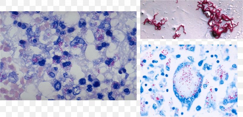 Miliary Tuberculosis Acid-fastness Ziehl–Neelsen Stain Gram Stain, PNG, 1627x789px, Tuberculosis, Acidfastness, Bacteria, Blue, Bone Marrow Download Free