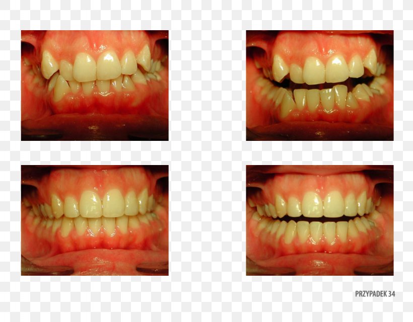 Tooth Orange Polska Close-up Therapy, PNG, 1024x800px, Tooth, Closeup, Jaw, Lip, Mouth Download Free