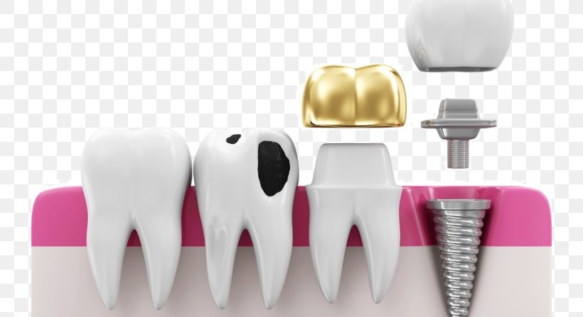 Crown Dentistry Dental Implant Bridge, PNG, 732x447px, Watercolor, Cartoon, Flower, Frame, Heart Download Free