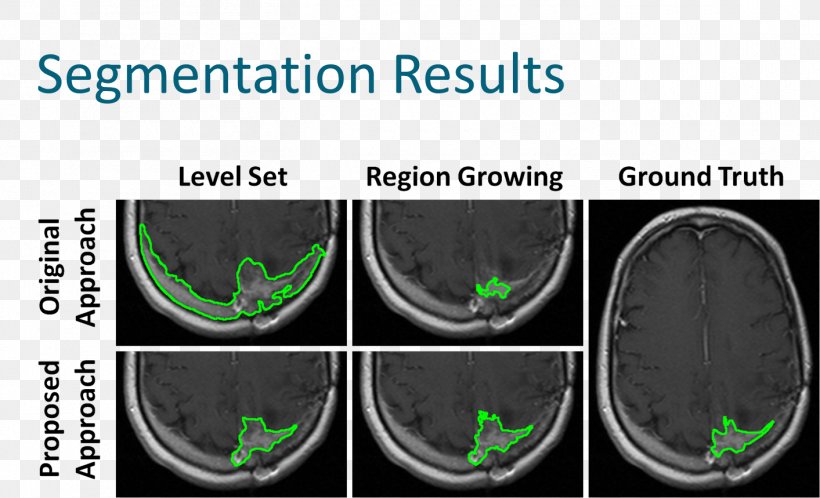 Image Segmentation Brain Tumor Magnetic Resonance Imaging Image Analysis Region Growing, PNG, 1413x859px, Image Segmentation, Automotive Tire, Brain Tumor, Brand, Computer Vision Download Free