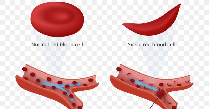 Sickle Cell Disease Anemia Sickle Cell Trait Red Blood Cell, PNG, 750x430px, Sickle Cell Disease, Anemia, Blood, Blood Cell, Disease Download Free