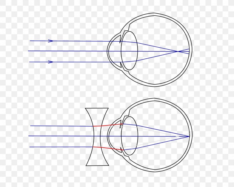 Near-sightedness Human Eye Visual Perception Hypermetropia, PNG, 1280x1024px, Nearsightedness, Area, Bates Method, Contact Lenses, Diagram Download Free