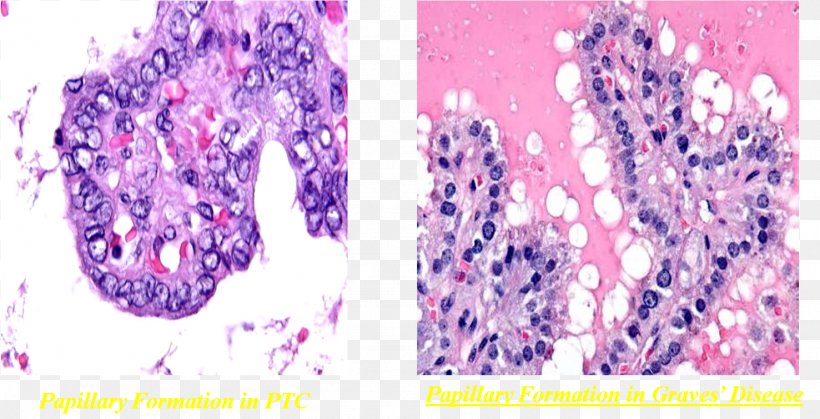 Thyroid Cancer Benign Tumor Goitre, PNG, 1477x755px, Cancer, Benign Tumor, Cell, Disease, Follicular Cell Download Free