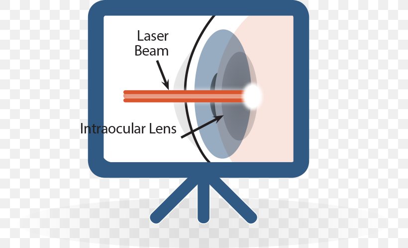 Cataract Surgery Laser Lens, PNG, 748x500px, Cataract, Blue, Brand, Cataract Surgery, Communication Download Free