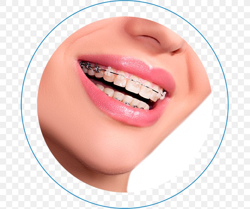 Dental Braces Orthodontics Clear Aligners Dentistry Self-ligating Bracket, PNG, 687x686px, Dental Braces, Cheek, Chin, Clear Aligners, Close Up Download Free