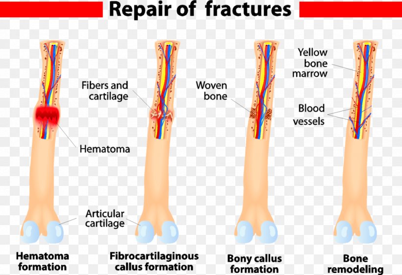 Bone Healing Bone Fracture Wound, PNG, 1024x703px, Watercolor, Cartoon, Flower, Frame, Heart Download Free