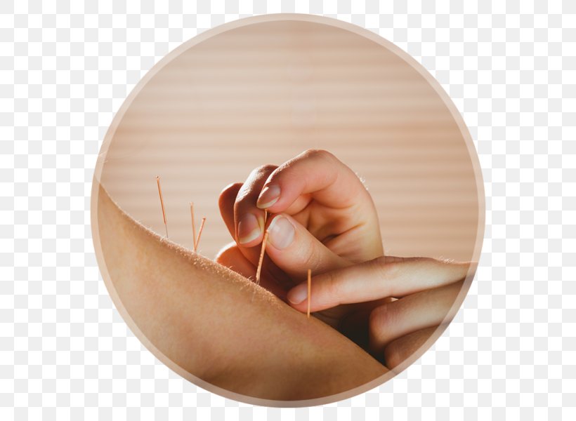 Dry Needling Myofascial Trigger Point Acupuncture Myotherapy Myofascial Release, PNG, 600x600px, Dry Needling, Ache, Acupuncture, Copper, Cupping Therapy Download Free