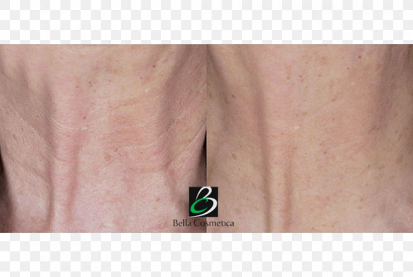 Neck Wrinkle Skin Hair Removal Cosmetics, PNG, 1060x713px, Neck, Acne, Beige, Chin, Cosmetics Download Free