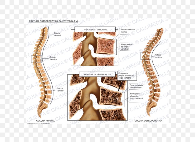 Osteoporosis Bone Fracture Vertebral Column Vertebral Compression Fracture, PNG, 600x600px, Watercolor, Cartoon, Flower, Frame, Heart Download Free