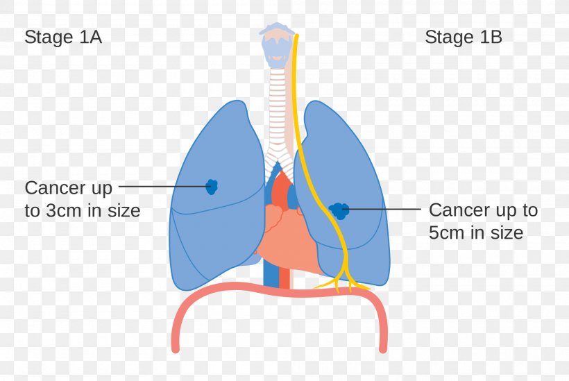 Lung Cancer Staging, PNG, 2000x1341px, Watercolor, Cartoon, Flower, Frame, Heart Download Free