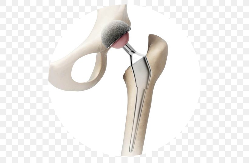 Hip Replacement Prosthesis Knee Replacement, PNG, 539x539px, Hip Replacement, Arthroscopy, Bone, Hip, Implant Download Free