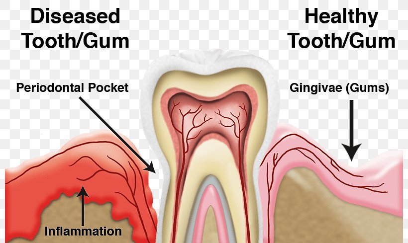 Periodontal Disease Gums Periodontology Dentistry, PNG, 800x489px, Watercolor, Cartoon, Flower, Frame, Heart Download Free