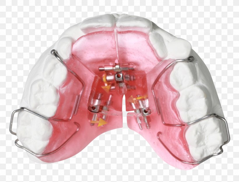 Gergen's Orthodontic Lab Orthodontic Technology Orthodontics Jaw Bionator, PNG, 1024x778px, Orthodontic Technology, Bionator, Dental Laboratory, Dentistry, Gergen Orthodontic Download Free