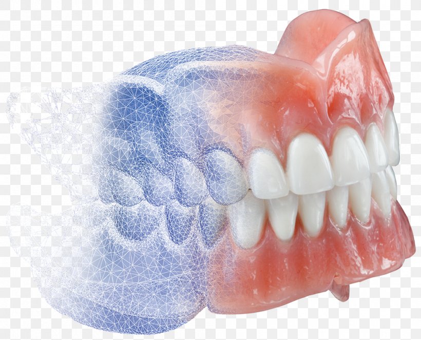 Dentures Burdette Dental Lab CAD/CAM Dentistry, PNG, 1000x808px, Dentures, Burdette Dental Lab, Cadcam Dentistry, Computer, Cone Beam Computed Tomography Download Free