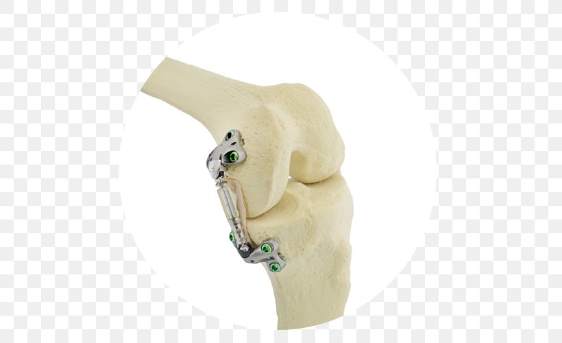 Knee Osteoarthritis Knee Osteoarthritis Knee Arthritis NASDAQ:SPNE, PNG, 500x500px, Knee, Business, Figurine, Joint, Knee Arthritis Download Free