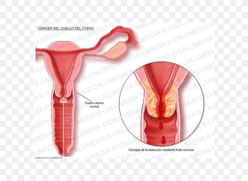 Cervical Cancer Uterine Cancer Cervix Uterus, PNG, 600x600px, Cervical Cancer, Breast Cancer, Cancer, Carcinoma, Carcinoma In Situ Download Free