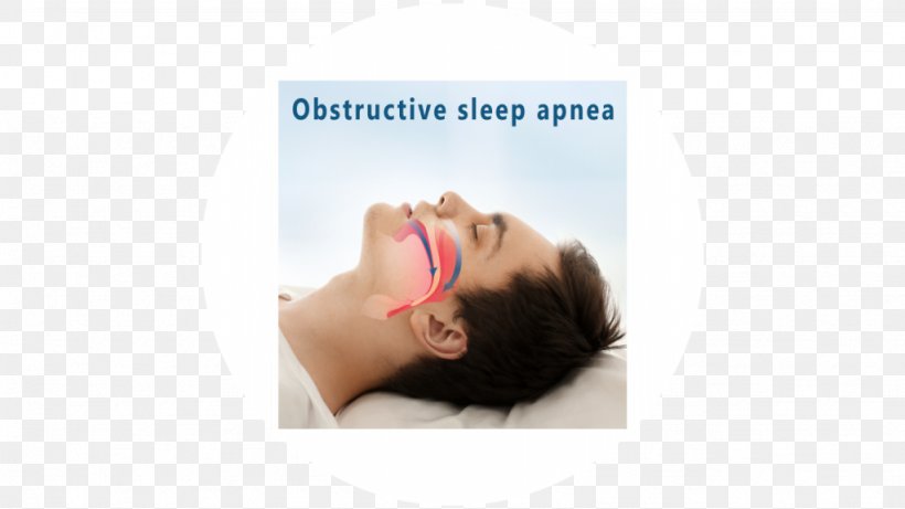 Obstructive Sleep Apnea In Adults, PNG, 1024x576px, Sleep Apnea, Apnea, Brand, Chin, Continuous Positive Airway Pressure Download Free