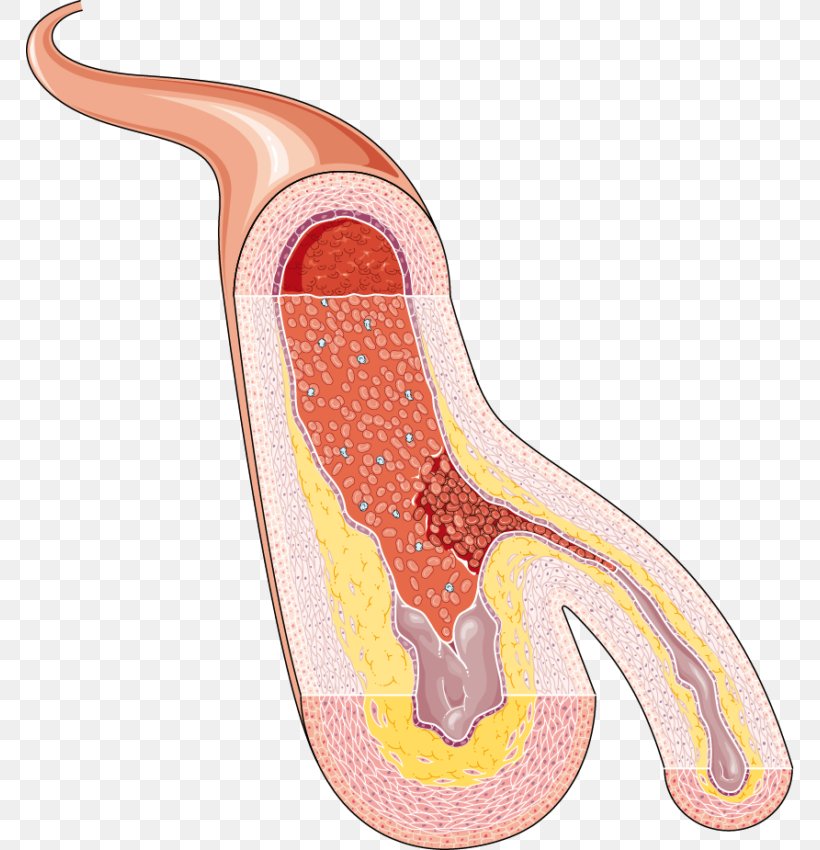 Atheroma Laser Processing In Manufacturing Arteriosclerosis Servier Medical, PNG, 768x850px, Watercolor, Cartoon, Flower, Frame, Heart Download Free