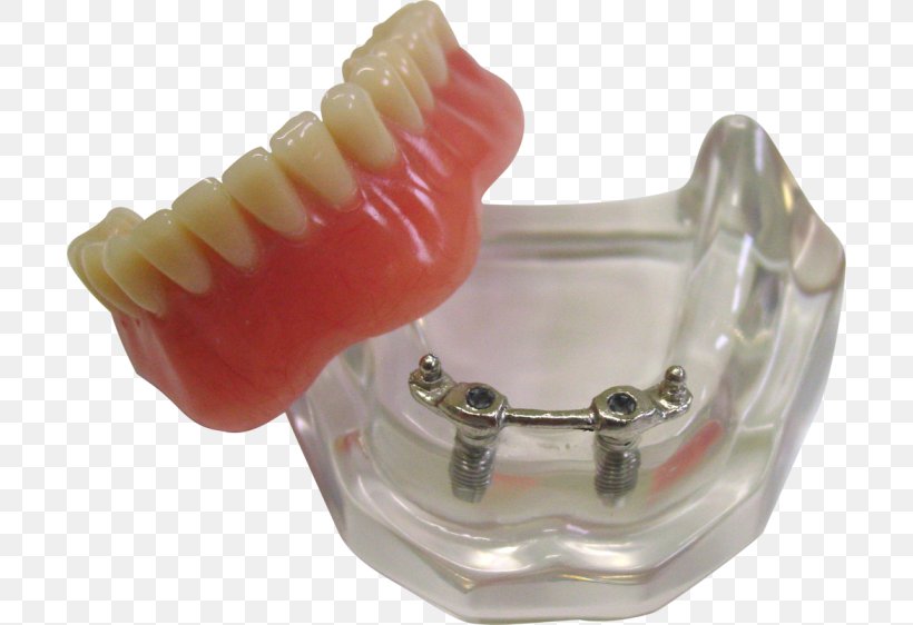 Tooth Mandible Dentures Jaw Anatomy, PNG, 700x562px, Tooth, Anatomy, Bone, Dentures, Gums Download Free