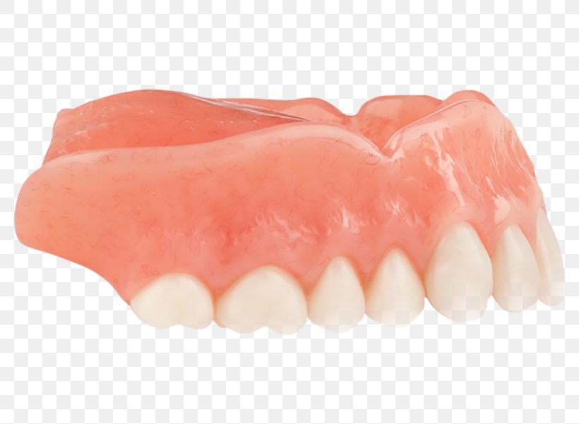 Tooth Dentures, PNG, 800x601px, Tooth, Dentures, Jaw, Lip, Mouth Download Free