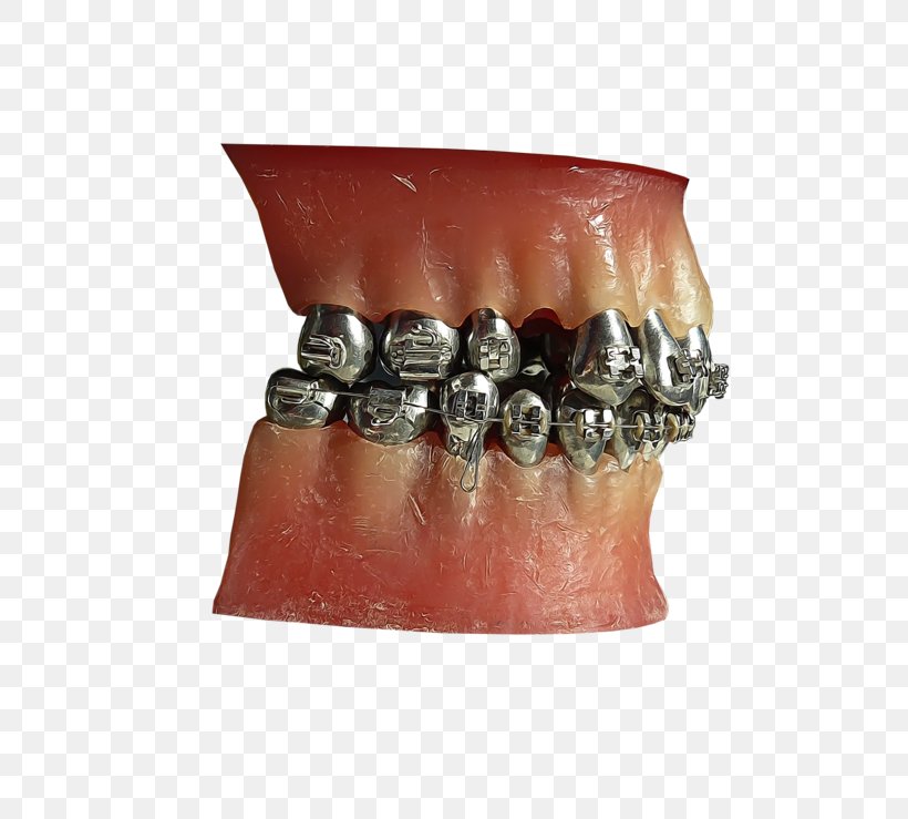 Human Tooth Metal Jaw DeviantArt, PNG, 800x739px, Human Tooth, Art, Artist, Community, Dental Braces Download Free