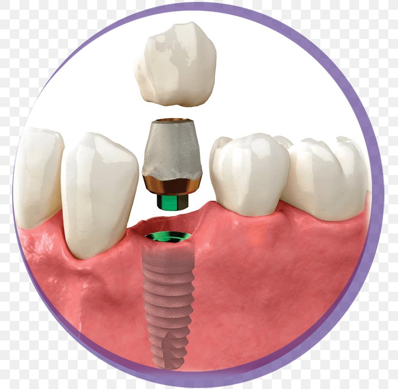 Tooth Dental Implant Crown Zimmer Biomet, PNG, 800x800px, Watercolor, Cartoon, Flower, Frame, Heart Download Free