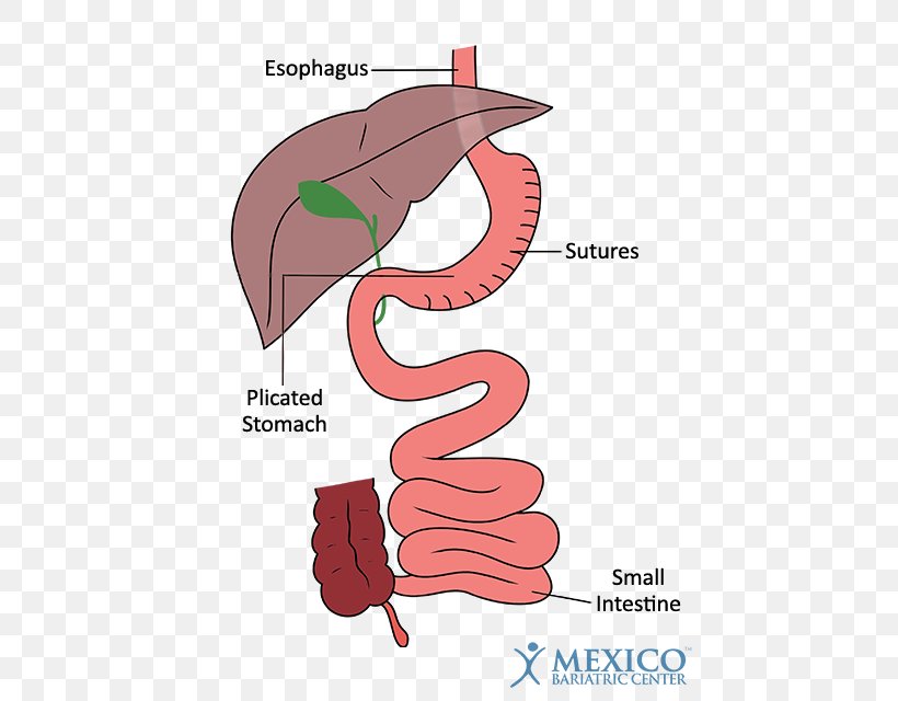 Duodenal Switch Bariatric Surgery Sleeve Gastrectomy Gastric Bypass Surgery, PNG, 450x640px, Watercolor, Cartoon, Flower, Frame, Heart Download Free