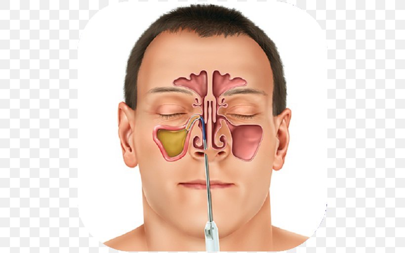 Sinus Infection Paranasal Sinuses Therapy Toothache, PNG, 512x512px, Sinus Infection, Ache, Allergy, Balloon Sinuplasty, Cheek Download Free