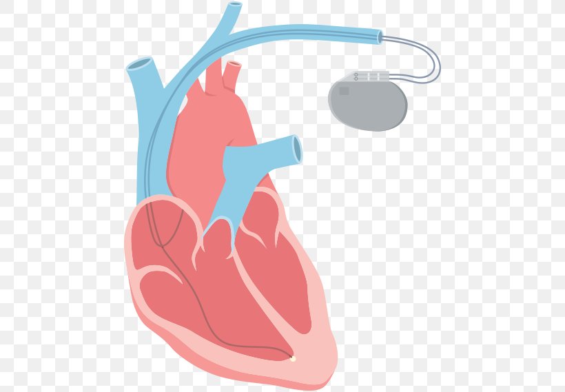 Heart Arrhythmia Clip Art Tachycardia Catheter Ablation, PNG, 464x569px, Watercolor, Cartoon, Flower, Frame, Heart Download Free