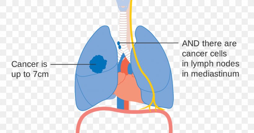 Lung Cancer Staging, PNG, 1200x630px, Watercolor, Cartoon, Flower, Frame, Heart Download Free