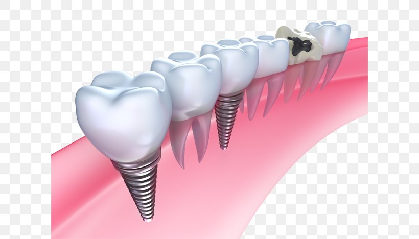 Dental Implant Dentistry Bridge, PNG, 620x468px, Watercolor, Cartoon, Flower, Frame, Heart Download Free
