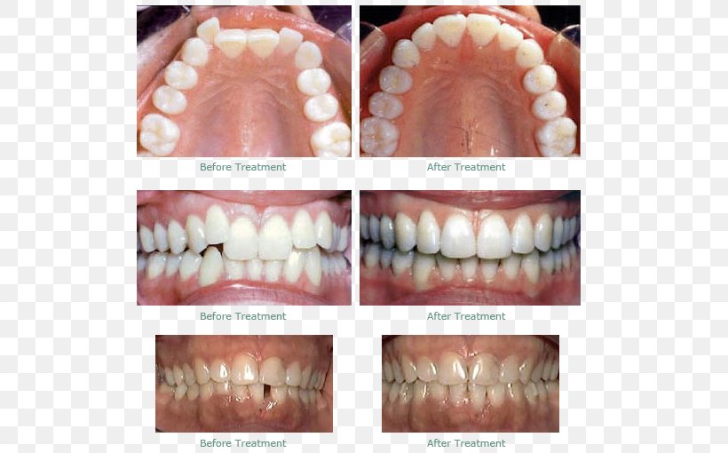 Dentistry Human Tooth Dental Braces Clear Aligners, PNG, 653x510px, Dentistry, Bridge, Clear Aligners, Cosmetic Dentistry, Crown Download Free