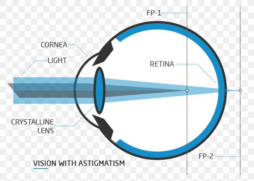 Floater Presbyopia Visual Perception Nd:YAG Laser Eye, PNG, 1050x750px, Floater, Astigmatism, Blurred Vision, Capsulotomy, Contact Lenses Download Free