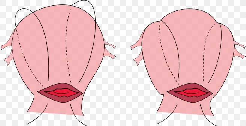 B-Lynch Suture Surgical Suture Postpartum Hemorrhage Uterine Atony Uterus, PNG, 1200x615px, Watercolor, Cartoon, Flower, Frame, Heart Download Free
