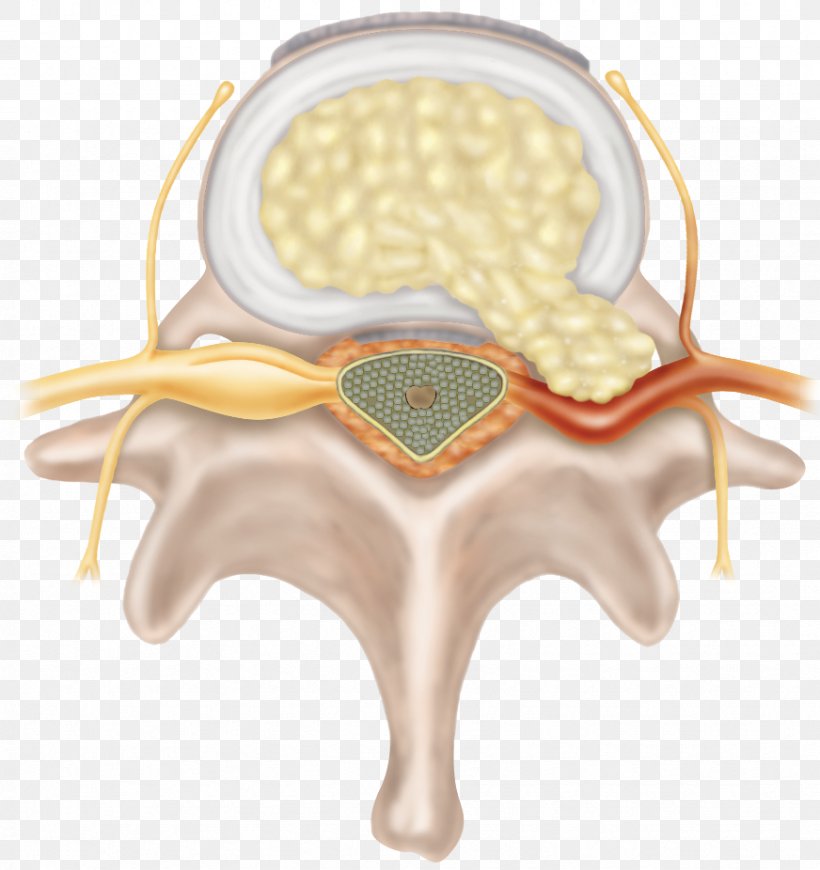 Spinal Disc Herniation Vertebral Column Intervertebral Disc Cervical Vertebrae Nerve Root, PNG, 872x926px, Watercolor, Cartoon, Flower, Frame, Heart Download Free