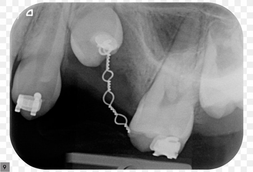 Tooth Alveolar Consonant Dental Implant Dental Extraction, PNG, 1072x730px, Tooth, Alveolar Consonant, Arm, Black And White, Consonant Download Free