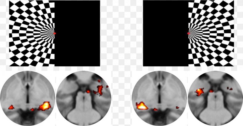 The Pusher Film Series Large Scale Brain Networks Pusher Syndrome Pusher-Symptomatik Pattern, PNG, 1302x676px, Pusher Film Series, Algorithm, Analysis, Joint, Large Scale Brain Networks Download Free