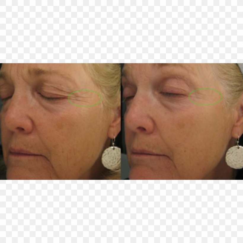 Cheek Wrinkle Anti-aging Cream Rhytidectomy Face, PNG, 900x900px, Cheek, Antiaging Cream, Chin, Cleanser, Close Up Download Free