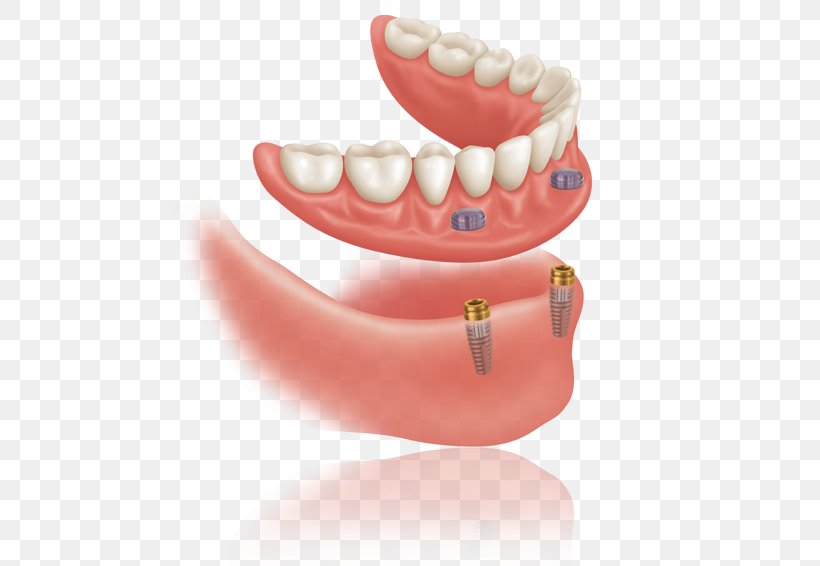 Dental Implant Dentures Dentistry, PNG, 474x566px, Dental Implant, Bridge, Cosmetic Dentistry, Dentist, Dentistry Download Free