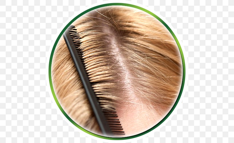 A Step By Step Guide To Treat Dandruff Naturally Hair Loss Scalp, PNG, 500x500px, Dandruff, Brush, Eyelash, Forehead, Hair Download Free