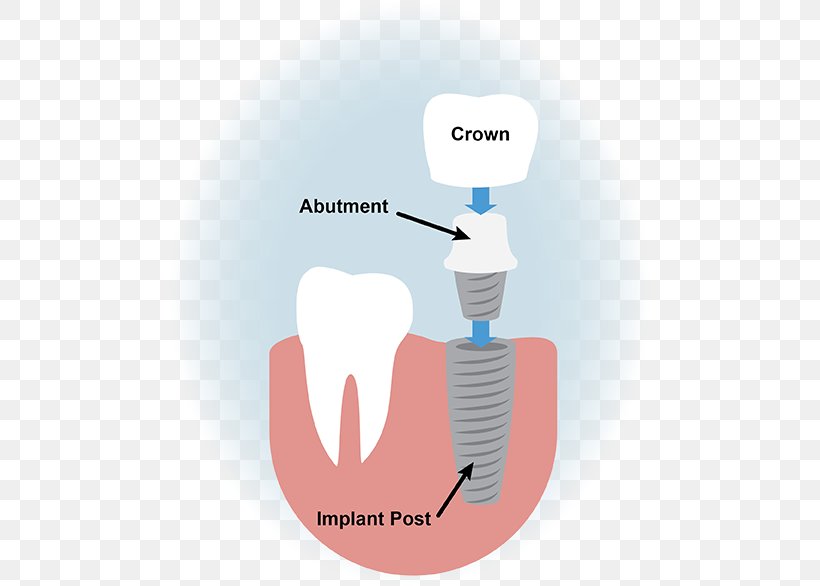 Dental Implant Dentistry Surgery, PNG, 483x586px, Watercolor, Cartoon, Flower, Frame, Heart Download Free