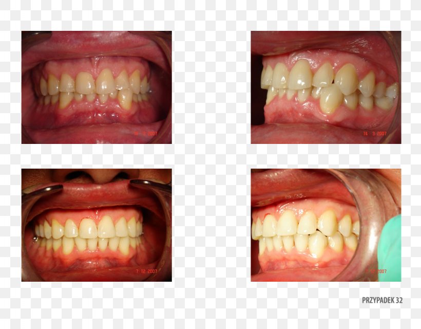 Tooth Close-up Therapy Patient .pl, PNG, 1024x800px, Tooth, Chin, Closeup, Cosmetic Dentistry, Jaw Download Free