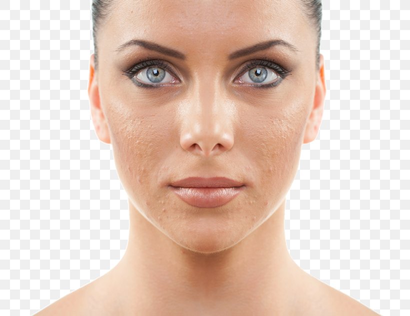 Chemical Peel Exfoliation Facial Skin Photorejuvenation, PNG, 720x633px, Chemical Peel, Acne, Beauty, Beauty Parlour, Cheek Download Free