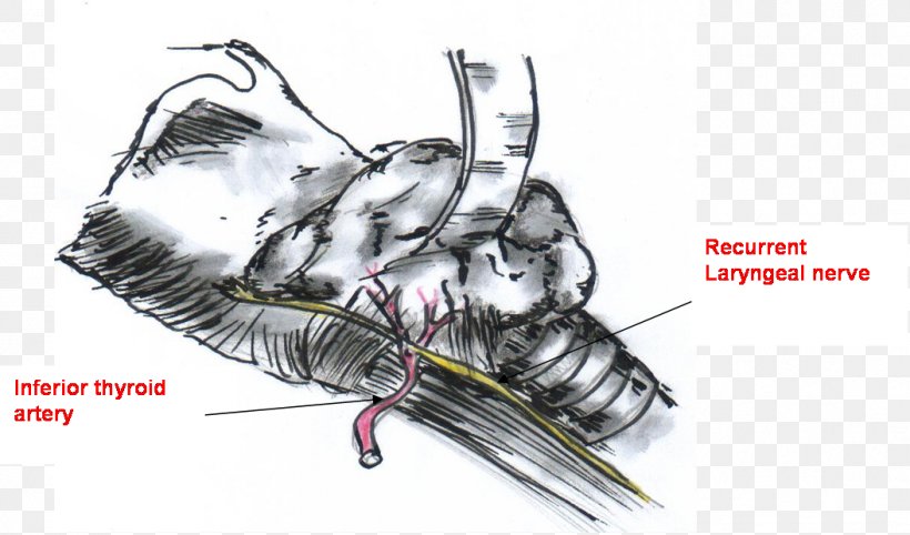 Recurrent Laryngeal Nerve Surgery Thyroidectomy /m/02csf Superior Laryngeal Nerve, PNG, 1054x620px, Recurrent Laryngeal Nerve, Artwork, Automotive Design, Claw, Decapoda Download Free
