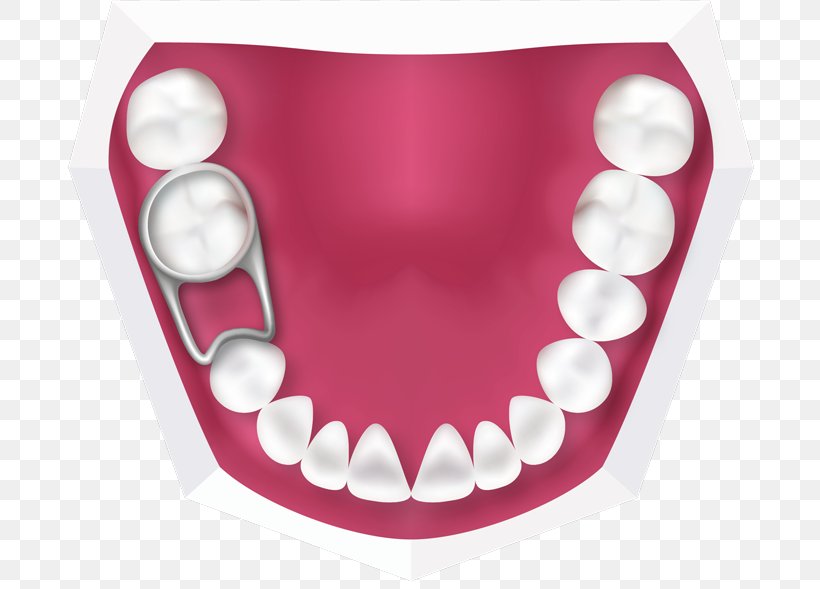 Tooth Deciduous Teeth Orthodontics Retainer Dentistry, PNG, 696x589px, Watercolor, Cartoon, Flower, Frame, Heart Download Free