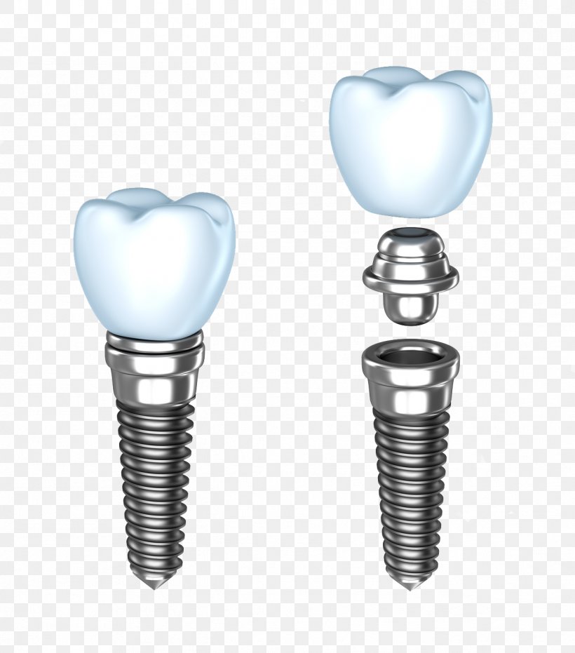 Dental Implant Dentistry Dentures Human Tooth, PNG, 1293x1469px, Dental Implant, Abutment, Body Jewelry, Bridge, Cosmetic Dentistry Download Free