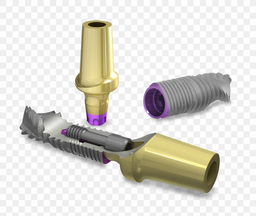 Dental Implant Dentistry Prosthesis, PNG, 1000x843px, Implant, Abutment, Bone, Dental Implant, Dentist Download Free